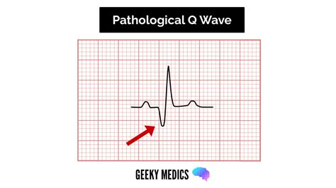 heartbeat q ave